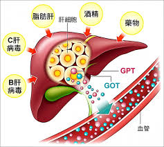 非酒精性脂肪肝病示意图